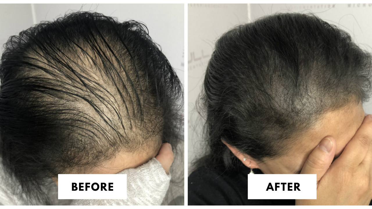 Post procedure care for Scalp Micropigmentation - Hair Ensure