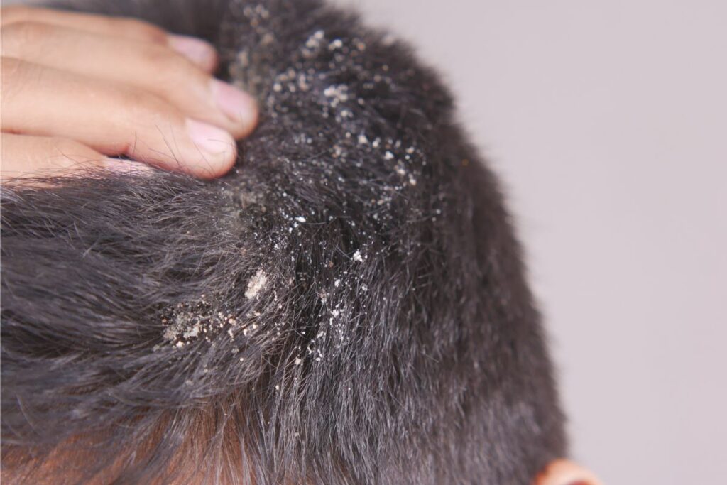 Treatment for Dandruff and Itchy Scalp